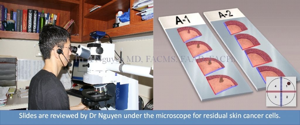 Mohs-slide-stills-microscope-watermark-1024x426 Mohs Micrographic Surgery Houston Dermatologist