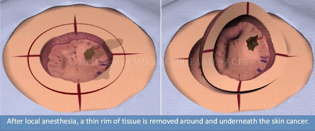 Mohs Micrographic Surgery