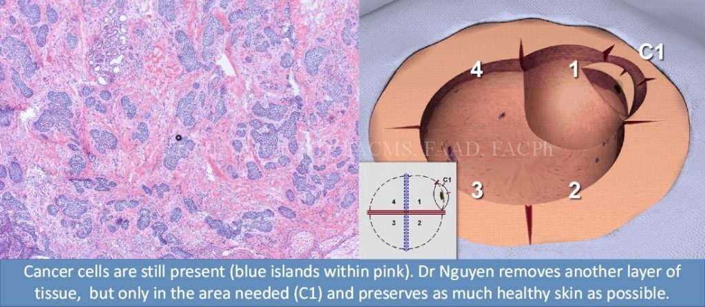 Mohs Micrographic Surgery