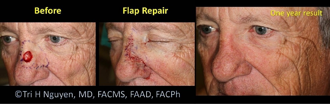 flap-repair-mohs-website Mohs Micrographic Surgery Houston Dermatologist