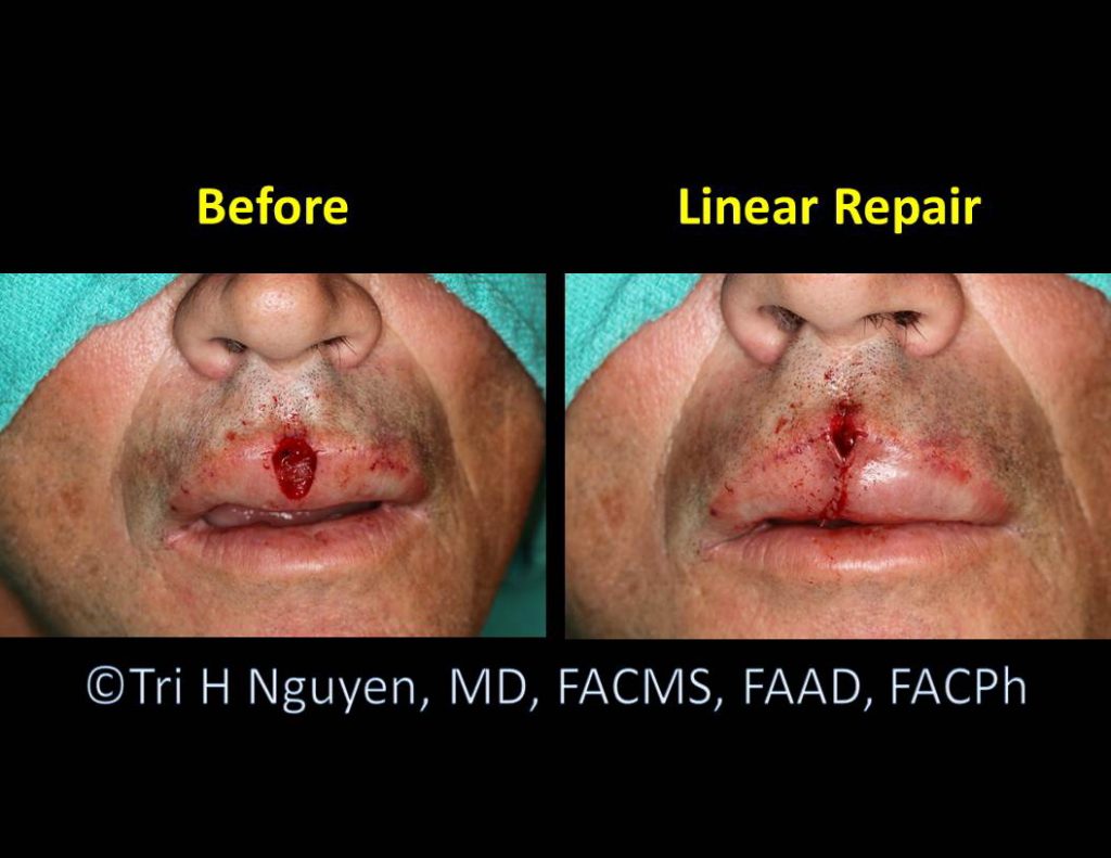 Lip-wound_Linear-repair-00041-1024x791 Reconstructive Surgery Houston Dermatologist