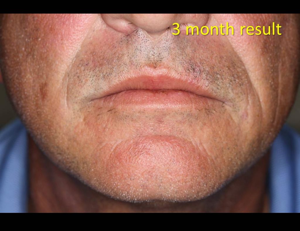 Lip-wound_Linear-repair-00052-1024x791 Reconstructive Surgery Houston Dermatologist