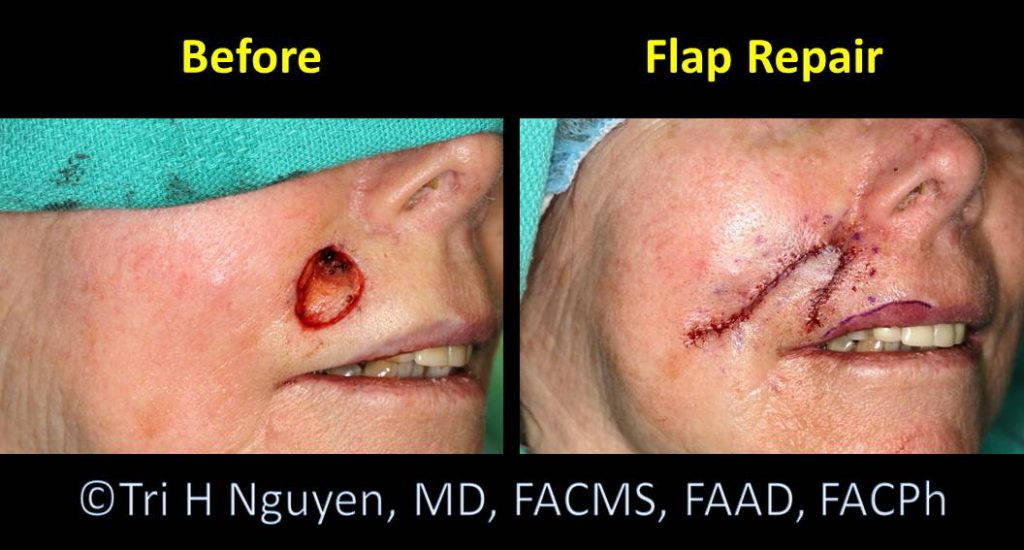 Houston Surgical Scar Removal