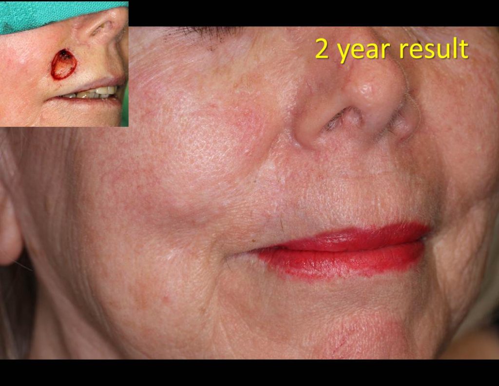 Lip_Flap-repair-00041-1024x791 Reconstructive Surgery Houston Dermatologist