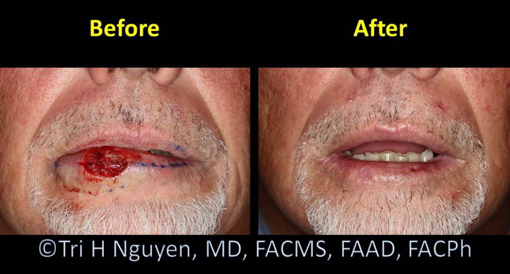 Mohs Surgery Daily Wound Care - Nose Incision