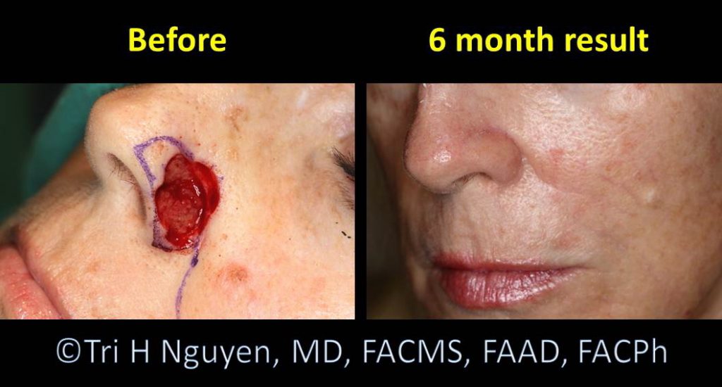 Mohs Surgery Daily Wound Care - Nose Incision