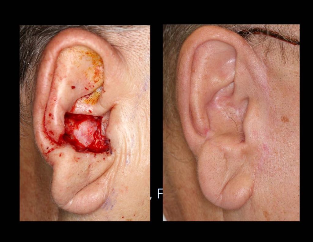 Preauricular-cheek_flap-repairs-0006-1024x791 Reconstructive Surgery Houston Dermatologist