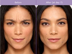 botox-before-and-after-photo-300x224 What is Botulinum Toxin Type A (Botox) Used for? Houston Dermatologist