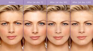 What is Botulinum Toxin Type A (Botox)? | The Woodlands, TX