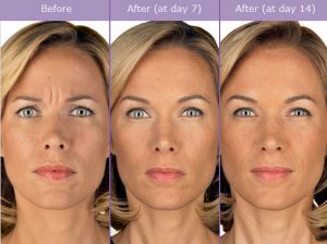 What is Botulinum Toxin Type A (Botox)? | The Woodlands, TX