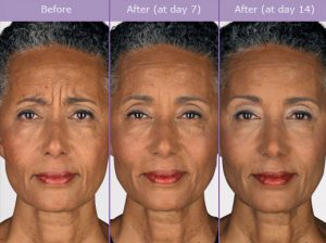 botox-before-and-after-pictures-300x224 Botox Candidates Houston Dermatologist