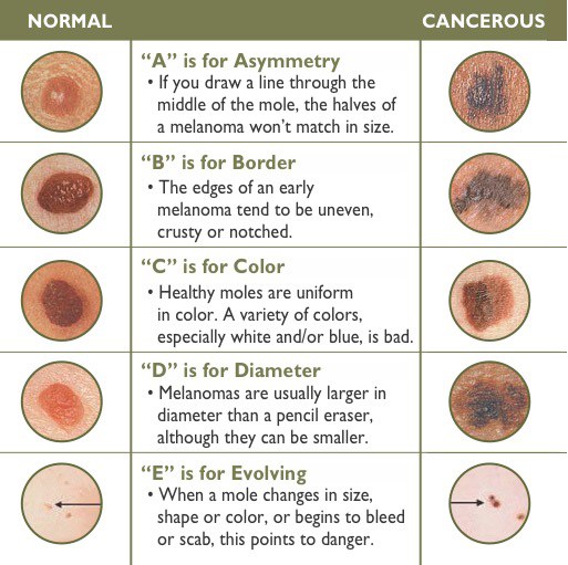 skin cancer types basal cell carcinoma