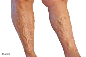 shutterstock_67825156-300x199 Varicose Vein Treatment Before and After Photos Houston Dermatologist