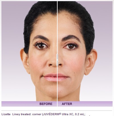 juvederm-3 What is the cost for Juvederm dermal filler? Houston Dermatologist