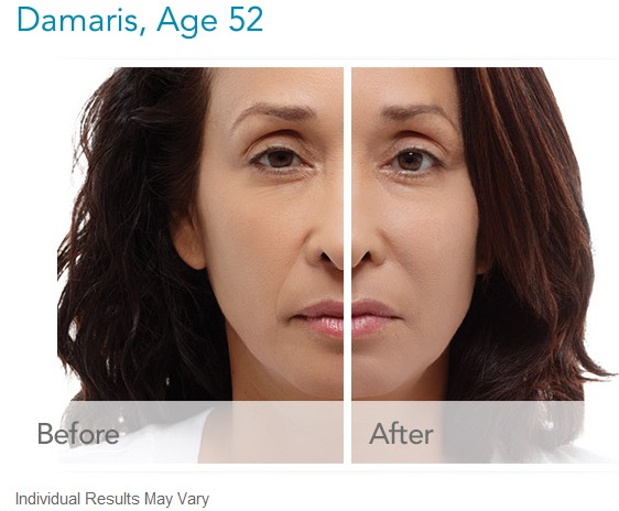 radiesse-before-and-after-gallery Radiesse Filler Injections Houston Dermatologist