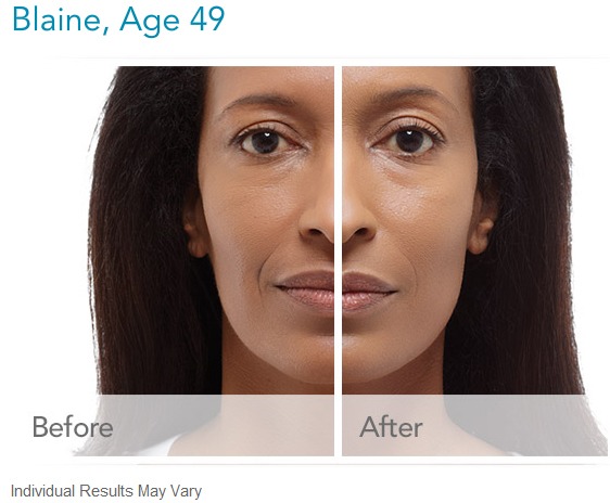 radiesse-before-and-after-images How much does Radiesse Facial Filler cost? Houston Dermatologist