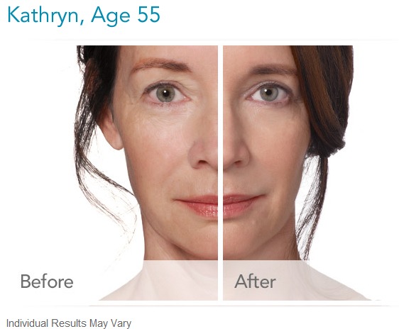 radiesse-before-and-after-photo Radiesse Dermal Filler Before and After Photos Houston Dermatologist