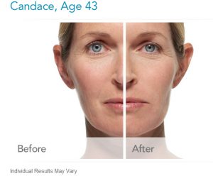 radiesse-before-and-after-photos-300x248 Radiesse Dermal Filler Before And After Photos Houston Dermatologist