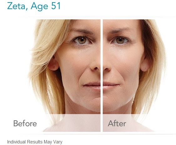 How long does Radiesse Dermal Filler Last?