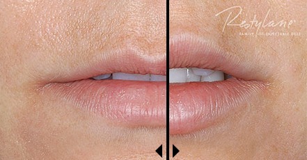 Restylane-Cost-before-and-after-photos What to expect during a consultation for Restylane dermal filler? Houston Dermatologist