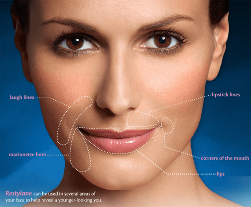 restylane What are the risks of Restylane dermal filler? Houston Dermatologist