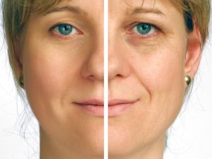 shutterstock_24655996-300x225 Dysport Before & After Photos Houston Dermatologist