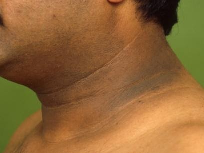 acanthosis nigricans neck