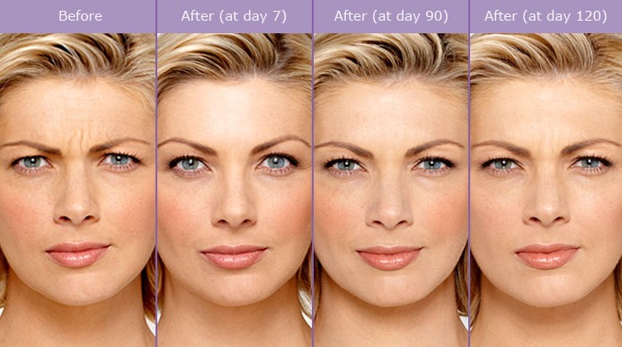 botox-before-and-after-photos Botox Injectable Uses and Possible Side Effects Houston Dermatologist