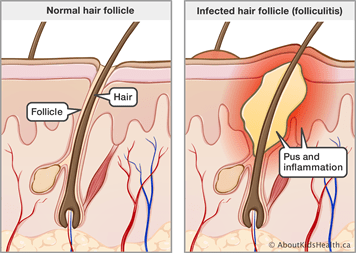 Folliculitis (infected hair follicle) Treatment | Houston Dermatologist |  The Woodlands Texas