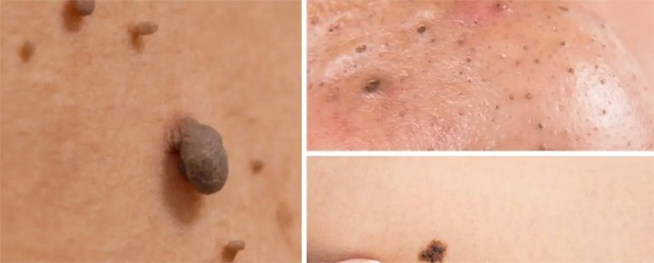 Mole Skin Tag Removal Spring Texas Houston The Woodlands Dermatolgist