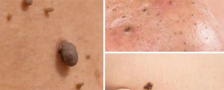 Skin Tag Removal!!! 