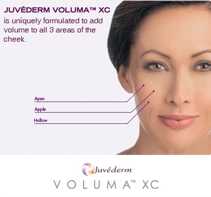 Juvederm-Voluma Dermal Fillers to Help Lift And Enhance Cheeks Houston Dermatologist