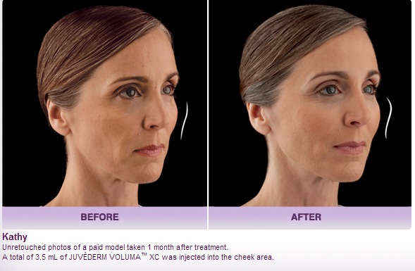juvederm-voluma-before-and-after-picture Dermal Fillers to Help Lift And Enhance Cheeks Houston Dermatologist