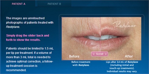 restylane_lips Dermal Fillers to Help Smooth Wrinkles Houston Dermatologist