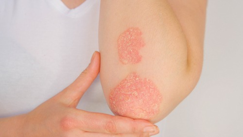 Psoriasis- Living With Psoriasis (And What to Do About It) Houston Dermatologist