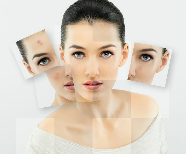 acne-cure-761x630 Medical, Surgical, And Cosmetic Dermatology Houston Dermatologist