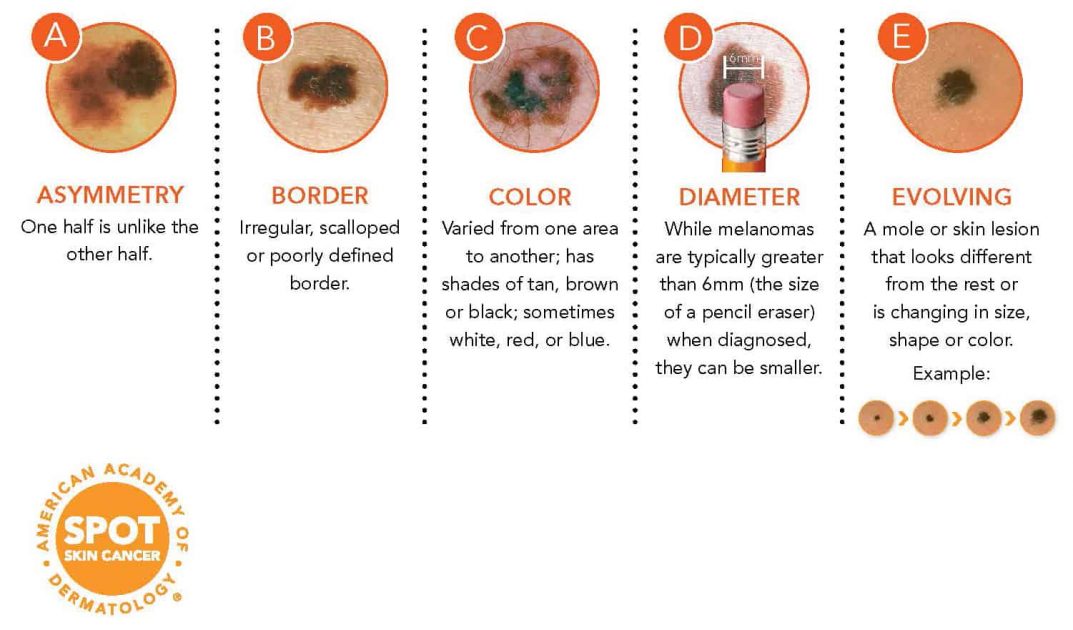 How to spot a melanoma — Dermatology Arts