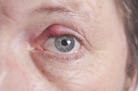 Boils-And-Stye-Causes-And-Treatment-1 Boils And Stye Causes And Treatment Houston Dermatologist