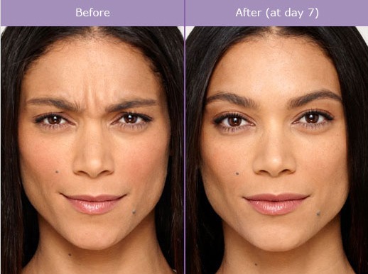 botox-before-and-after-photos-1 Botox Brow And Forehead Lift Houston Dermatologist