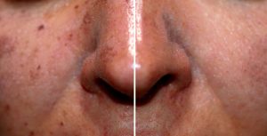 Laser-Skin-Resurfacing-To-Remove-Sun-Damage-Houston-Texas-300x153 Laser Skin Resurfacing To Remove Sun Damage Houston Dermatologist