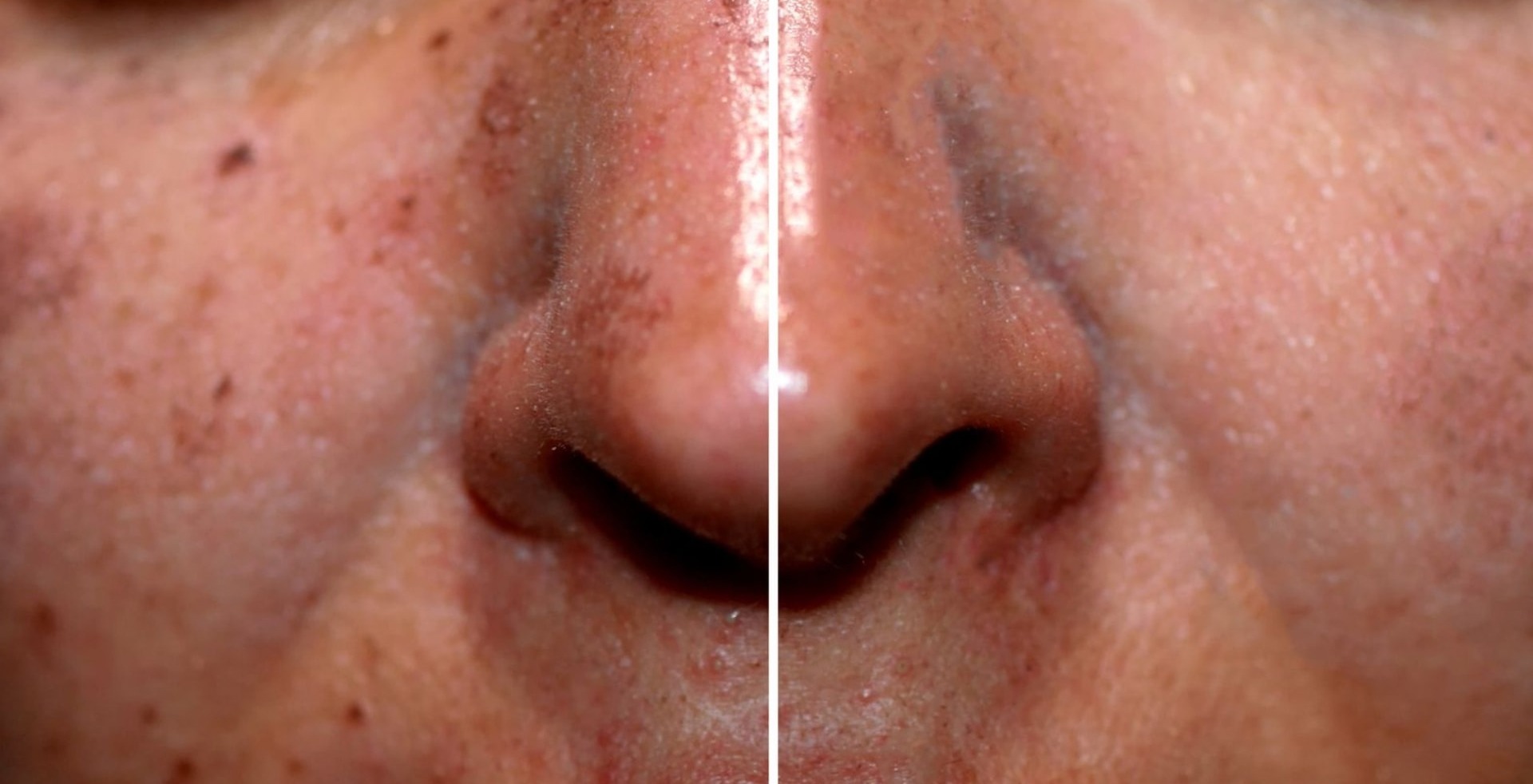 Laser Skin Resurfacing To Remove Sun Damage Houston, Woodlands