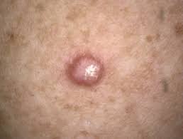 Atypical-Fibroxanthoma-skin-cancer Atypical Fibroxanthoma (AFX) Skin Cancer Treatment Houston Dermatologist
