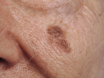 Lentigo-Maligna-LM Lentigo Maligna (LM) Skin Cancer Treatment Houston Dermatologist