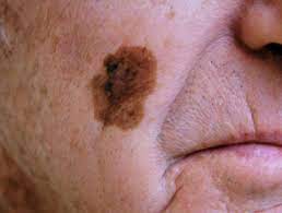 Lentigo-Maligna-Melanoma-LMM-Skin-Cancer-Treatment Lentigo Maligna Melanoma (LMM) Skin Cancer Treatment Houston Dermatologist