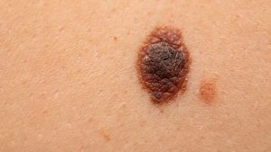 Types of Skin Cancer Treated with Mohs Surgery