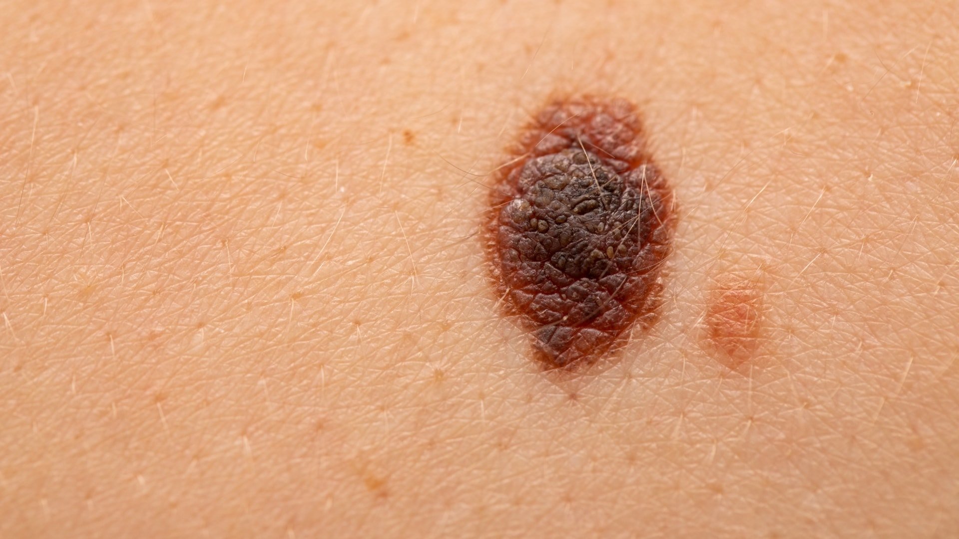 Is Stage 4 Malignant Melanoma Curable